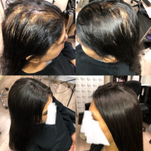 How to Combat Hair Loss in Women